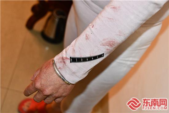 被害人與嫌疑人開展搏斗后的傷痕.jpg